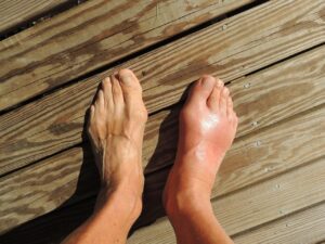 feet, gout, pain, foot, human, anomaly, barefoot, flatfoot, toes, ankle, sole, brown pain, brown human, gout, gout, gout, gout, gout, pain, foot